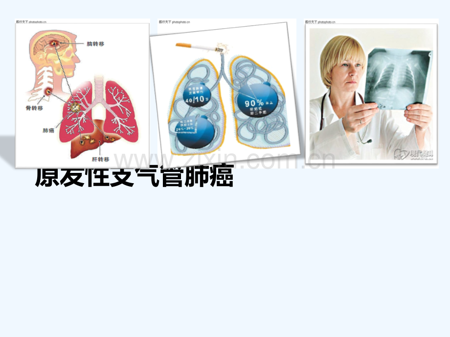 内科护理学肺癌.ppt_第2页