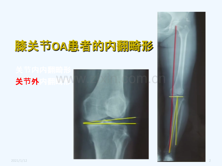 胫骨高位截骨治疗膝关节骨性关节炎.ppt_第2页