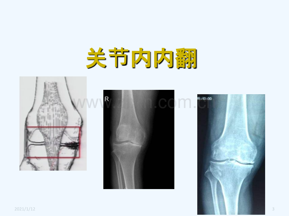 胫骨高位截骨治疗膝关节骨性关节炎.ppt_第3页