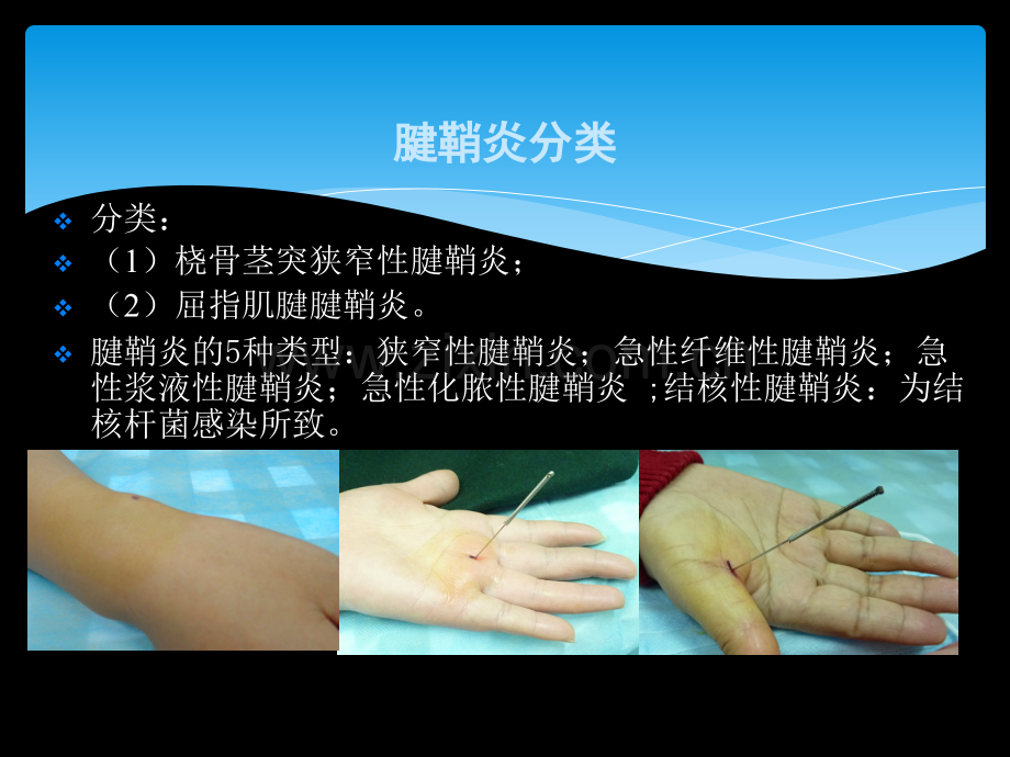 狭窄性腱鞘炎针刀治疗.ppt_第3页