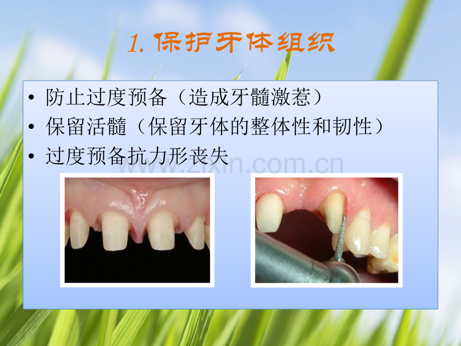 牙体预备的基本要点.ppt_第3页