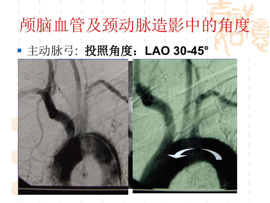 PPT医学课件脑血管造影的体位讲义.ppt_第1页