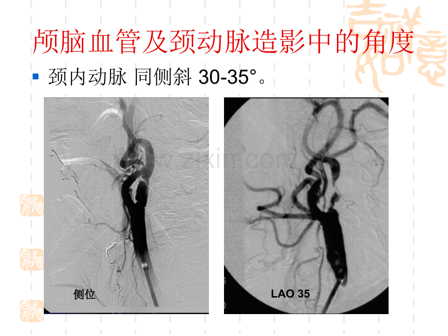 PPT医学课件脑血管造影的体位讲义.ppt_第3页