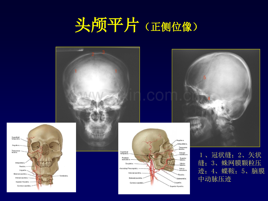 医学中枢神经系统影像学讲座PPT培训课件.ppt_第3页