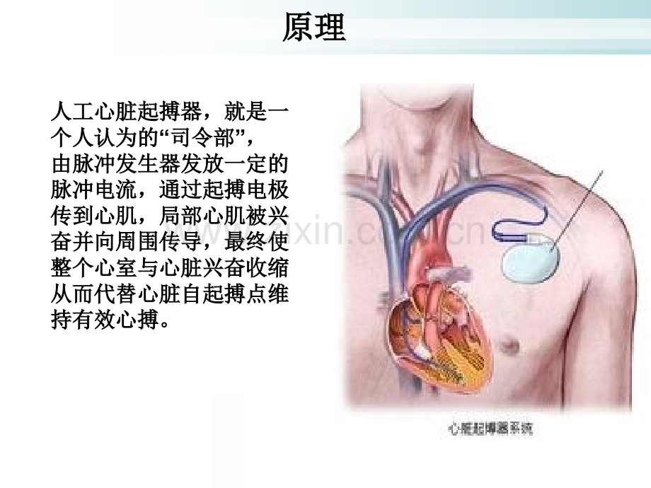 永久起搏器植入病人护理及相关注意事项.ppt_第3页