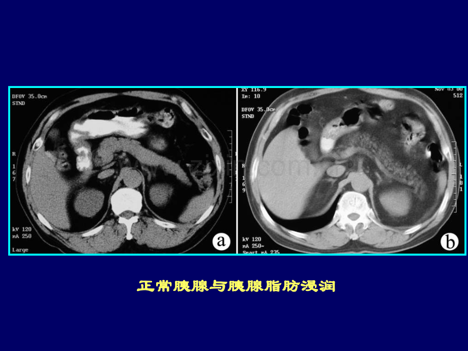 PPT医学课件胰腺常见病变的CT诊断讲义.ppt_第2页