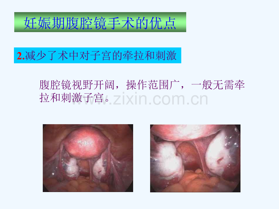 妊娠期腹腔镜手术.pptx_第3页