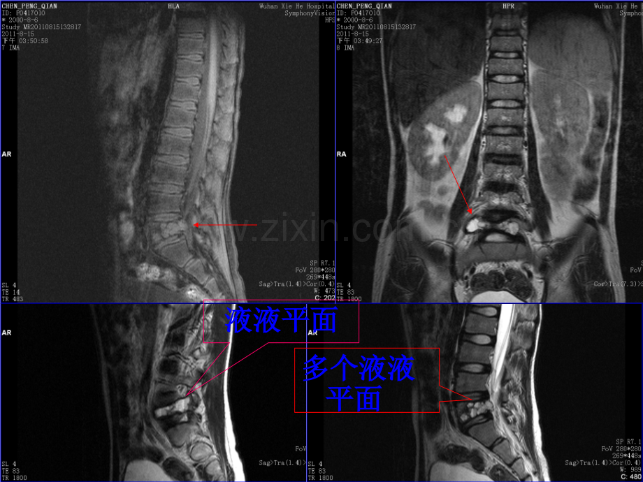 出现液液平面的肌骨系统病变讲义.ppt_第2页