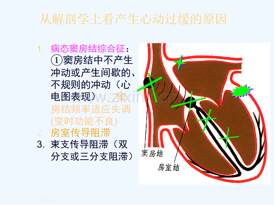 心脏起搏器简述.ppt_第3页