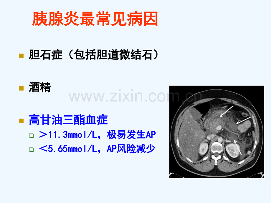 血浆置换治疗高脂血症性重症急性胰腺炎.pptx_第2页