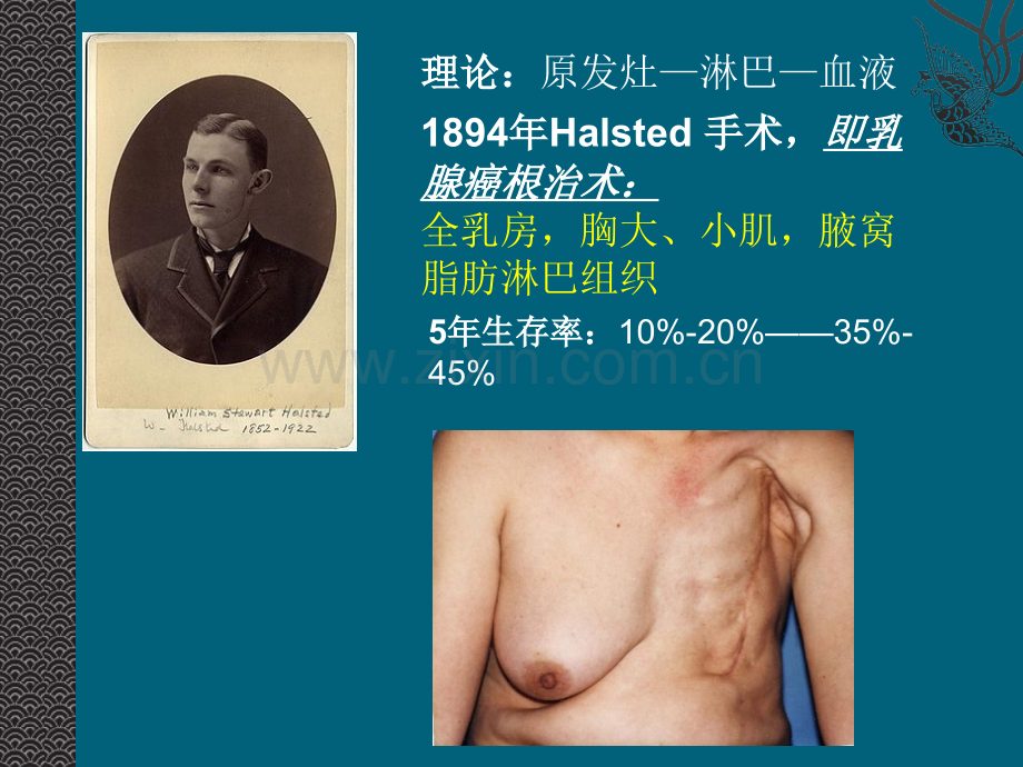 乳腺癌的手术治疗宣讲ppt培训课件.ppt_第3页