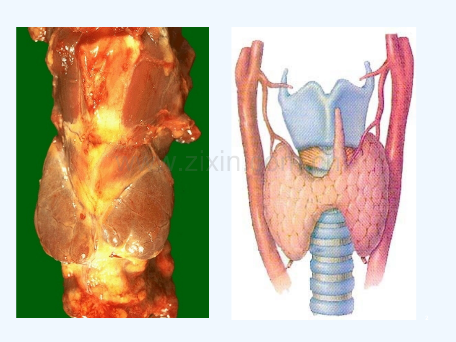 内分泌系统∶甲状腺疾病.ppt_第2页