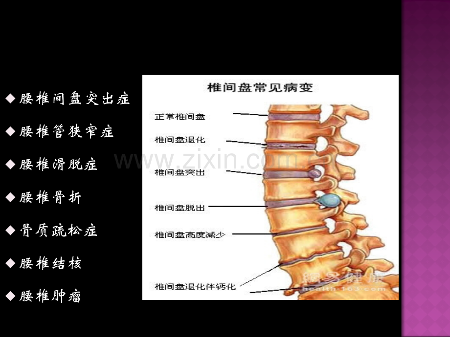 常见腰椎疾病诊断及治疗.ppt_第2页