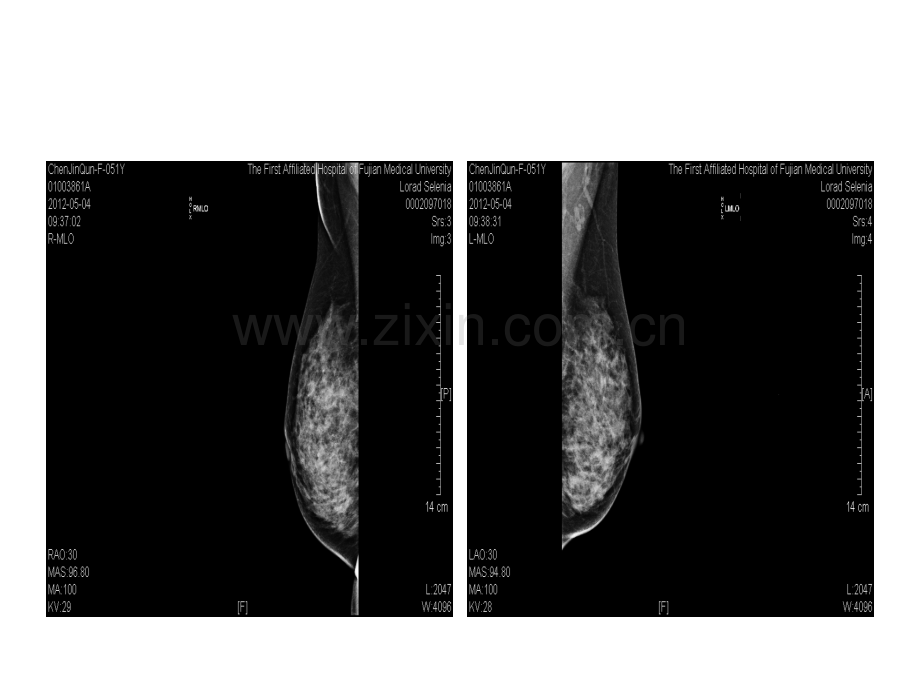 医学乳腺病例医学知识宣讲PPT培训课件.ppt_第2页