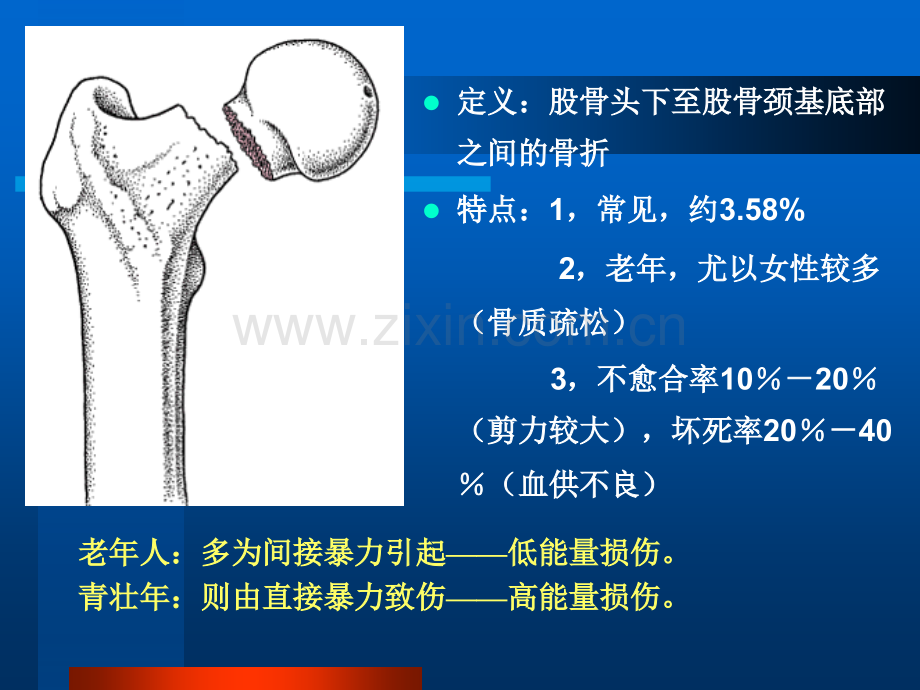 股骨颈骨折护理PPT模板.ppt_第2页