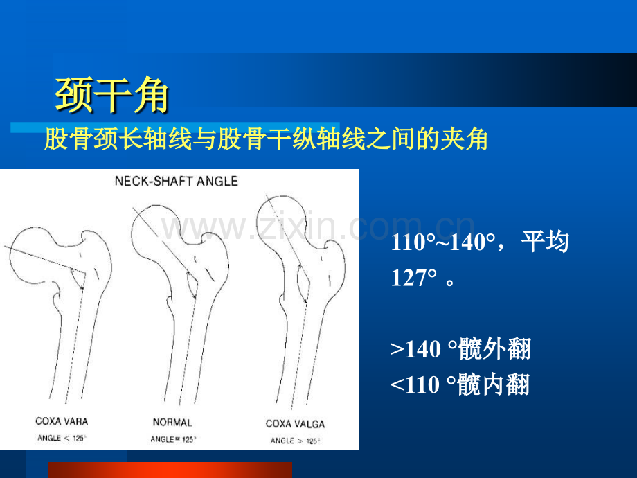 股骨颈骨折护理PPT模板.ppt_第3页