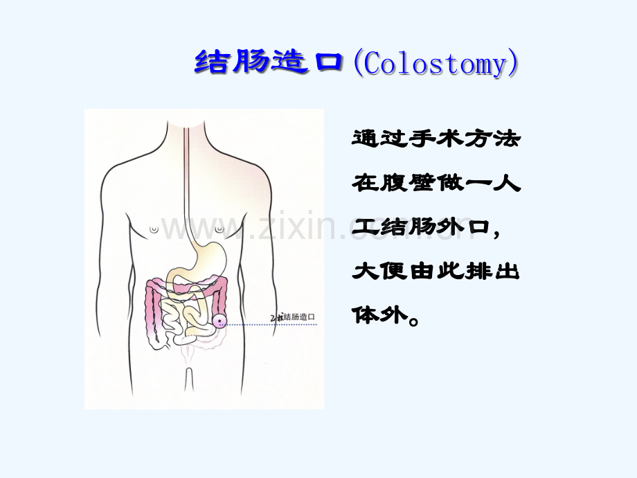 王泠讲义-造口病人的护理.pptx_第2页