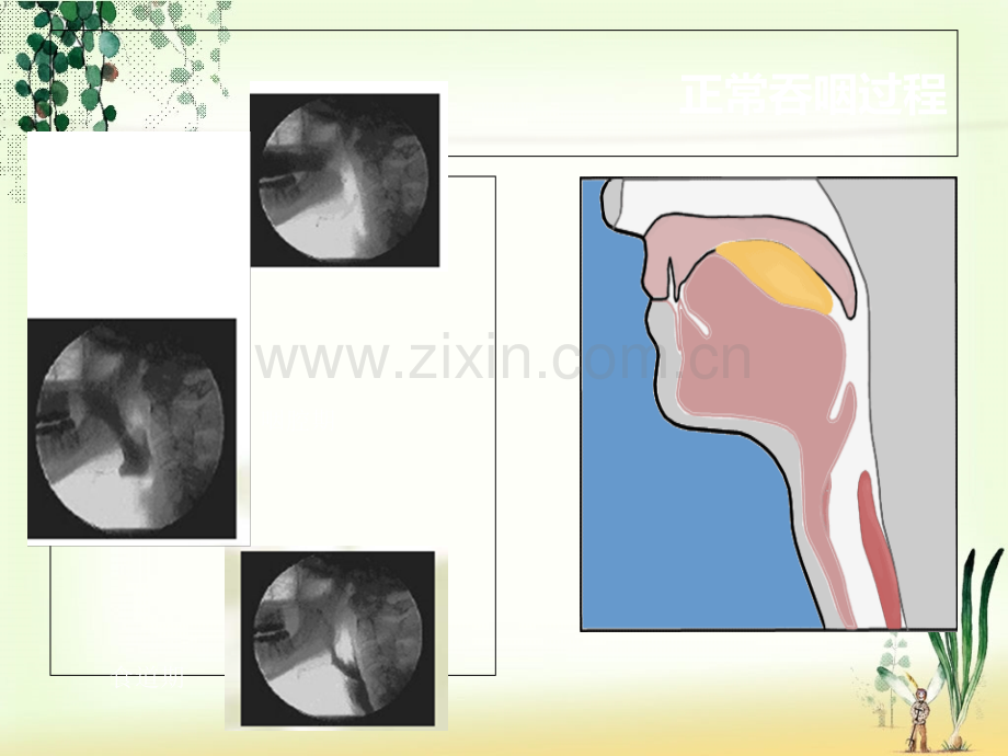 吞咽障碍的临床治疗.ppt_第3页