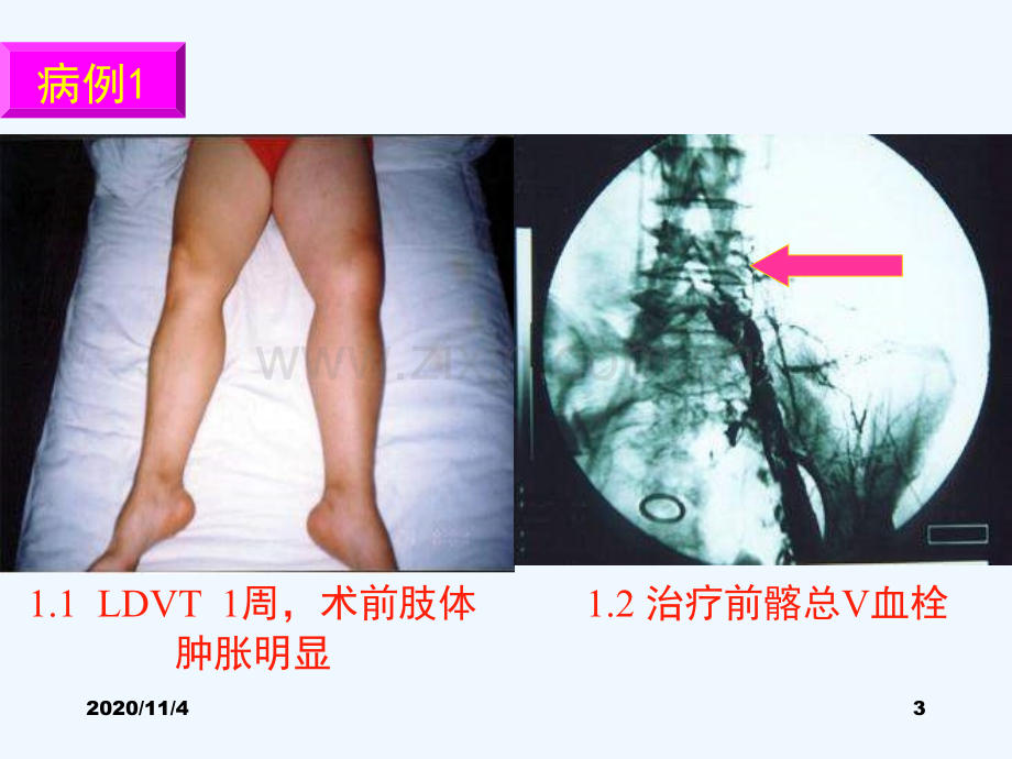 急性下肢深静脉血栓形成外科治疗病例分析解析.ppt_第3页