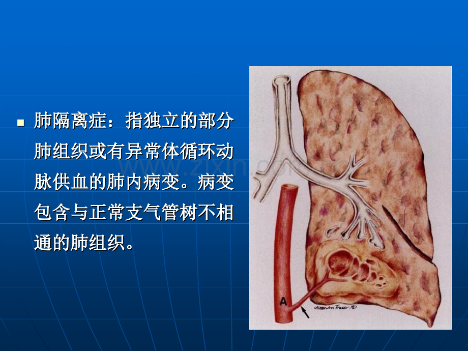 PPT医学课件肺隔离症医学知识专题讲座讲义.ppt_第1页