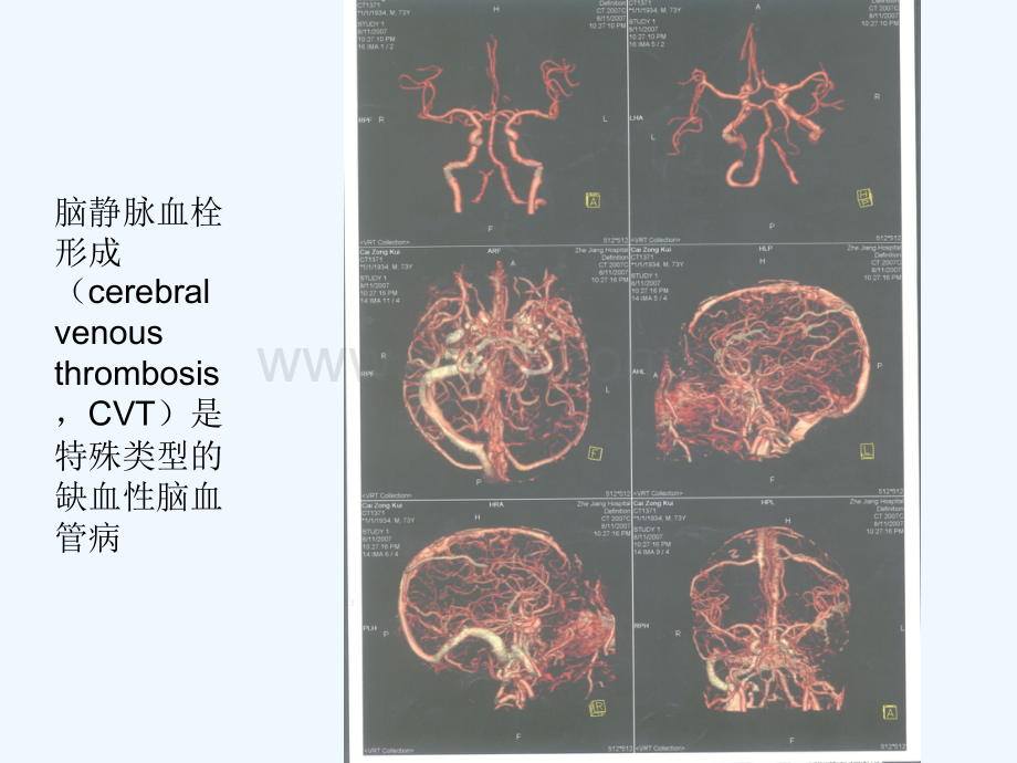 脑血栓形成的治疗.ppt_第2页