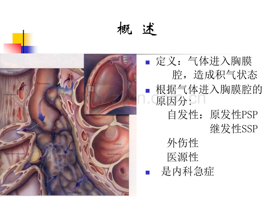 内科学气胸专业知识讲座PPT培训课件.ppt_第2页