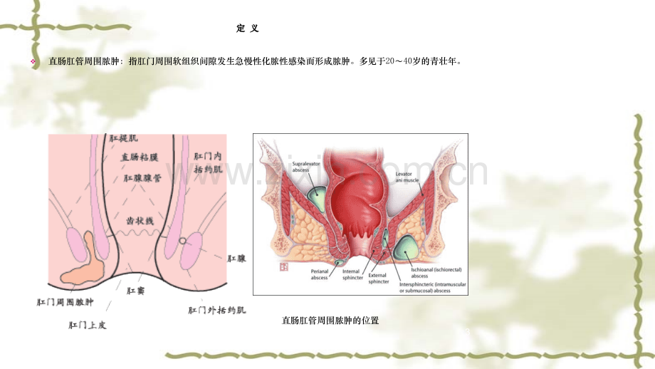 肛周脓肿诊断与治疗.ppt_第3页