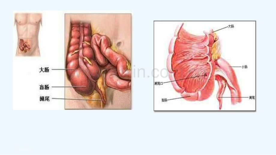 开腹阑尾的护理查房PPT.pptx_第3页