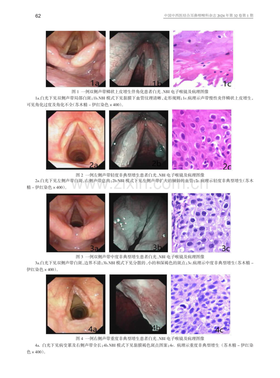喉白斑的窄带成像内镜下诊断与病理分析.pdf_第3页