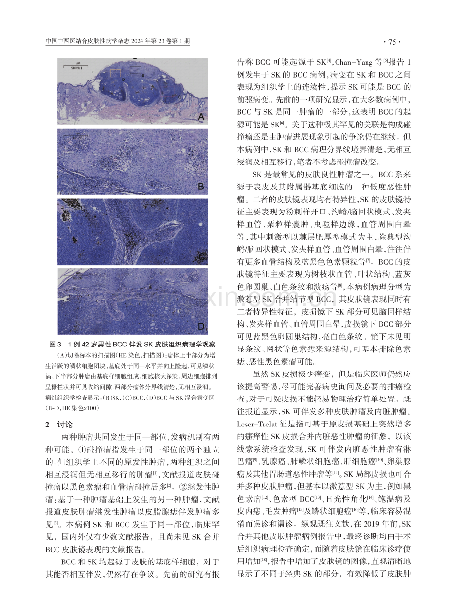 基底细胞癌伴发脂溢性角化皮肤镜表现1例.pdf_第2页