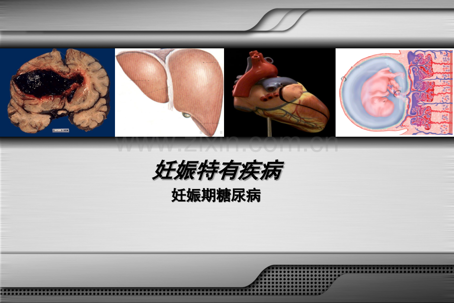 妊娠期糖尿病医学课件.ppt_第1页