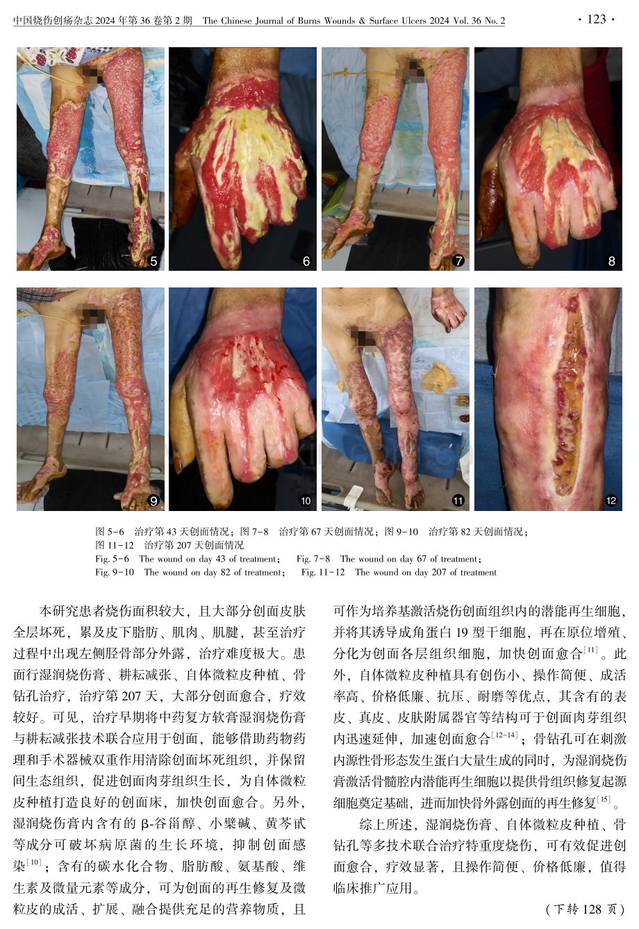 多技术联合治愈特重度烧伤1例报告.pdf_第3页