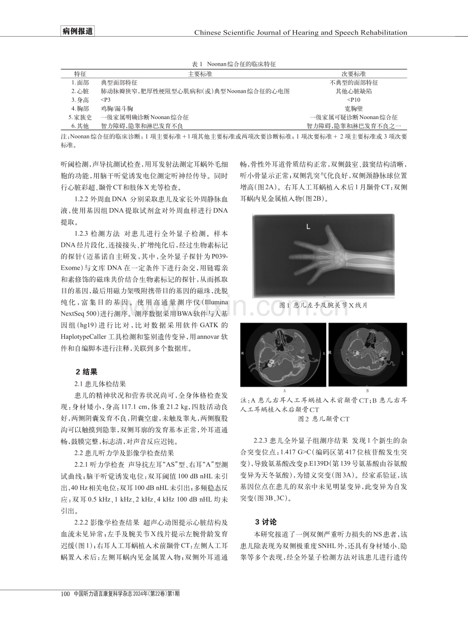 Noonan Syndrome患儿临床特征及致病基因分析.pdf_第2页