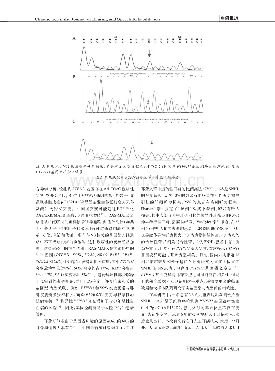 Noonan Syndrome患儿临床特征及致病基因分析.pdf_第3页