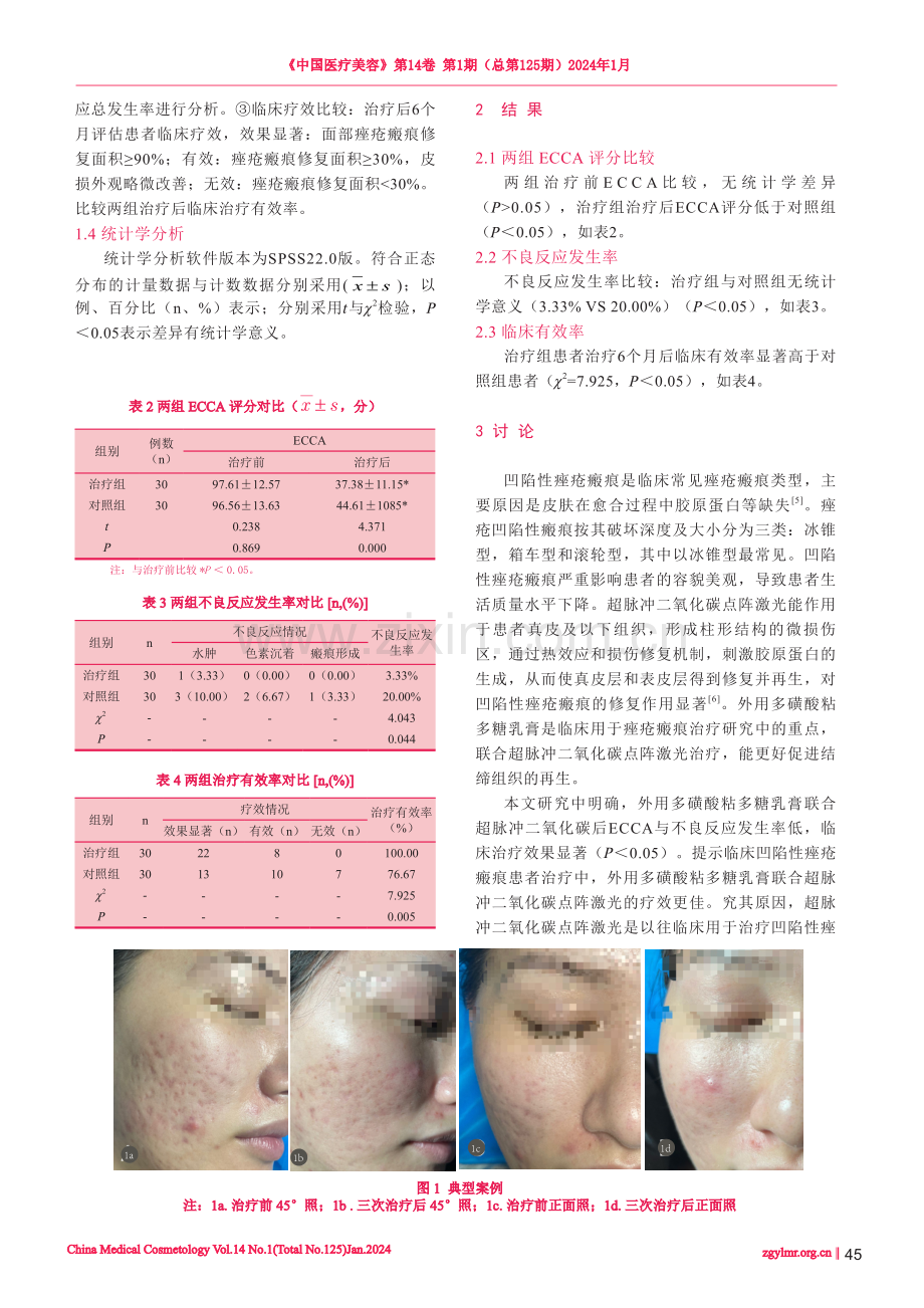 超脉冲二氧化碳点阵激光联合多磺酸粘多糖乳膏治疗凹陷性痤疮瘢痕的临床效果.pdf_第3页