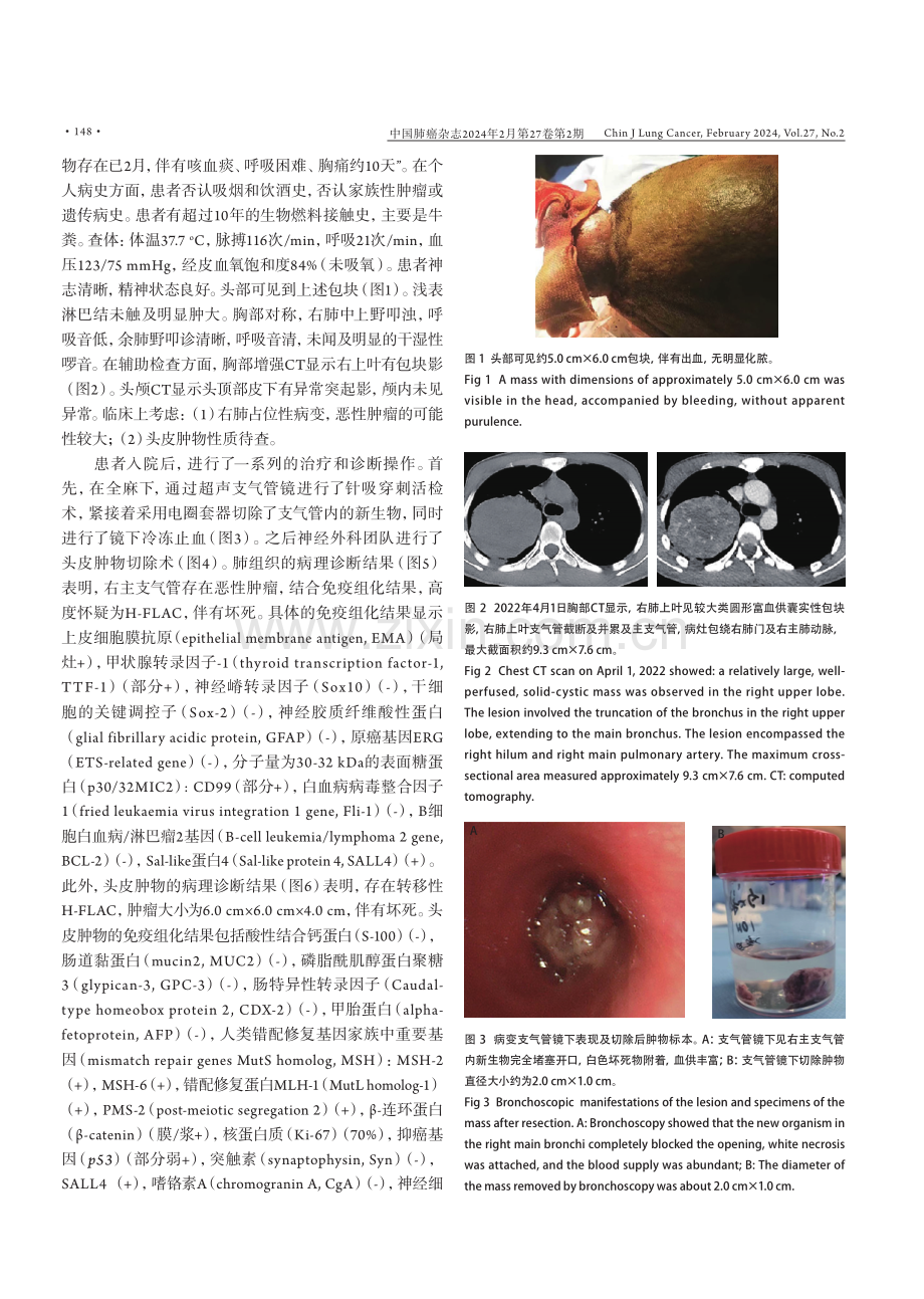 高级别胎儿型肺腺癌并头皮转移1例.pdf_第2页