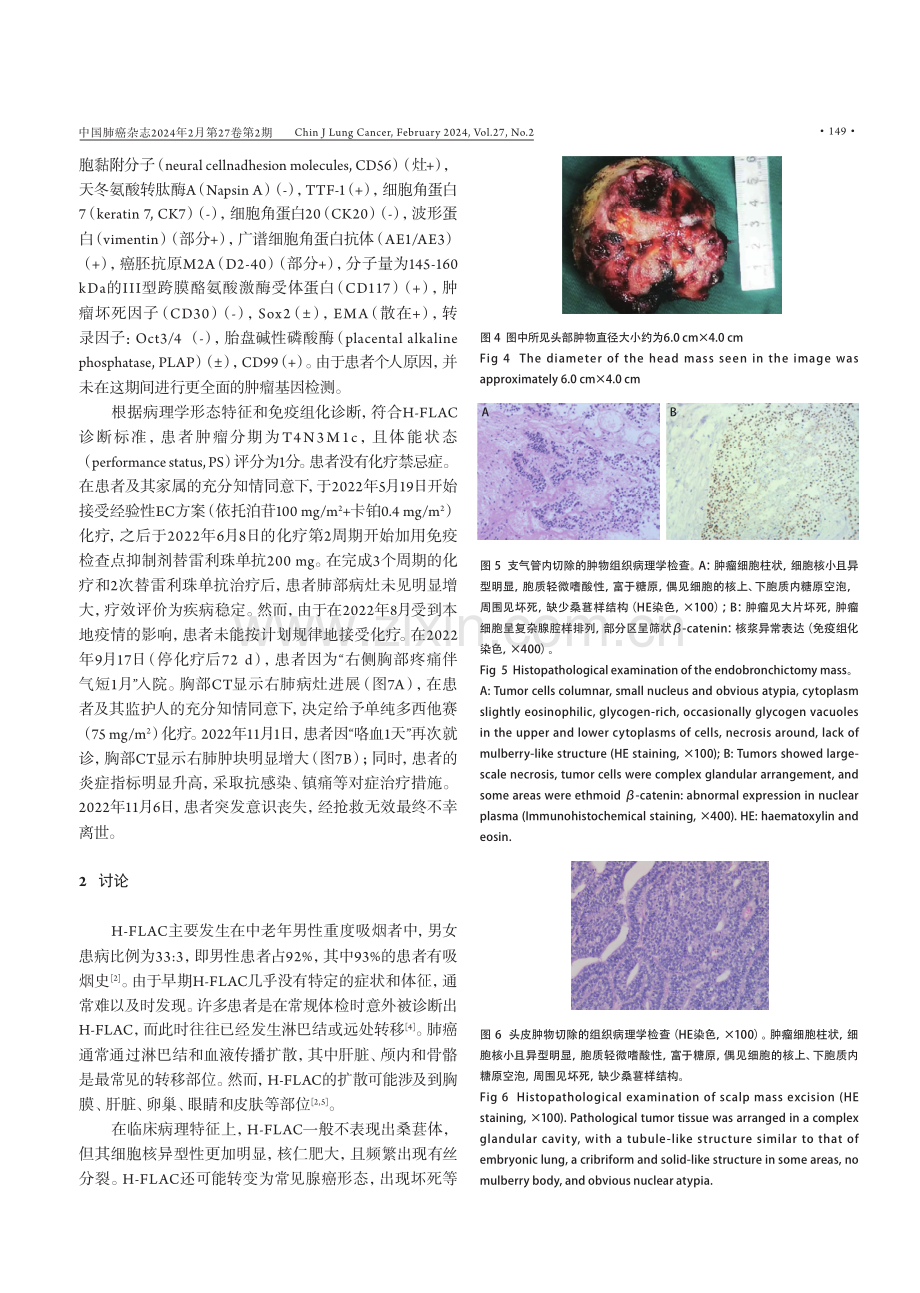 高级别胎儿型肺腺癌并头皮转移1例.pdf_第3页