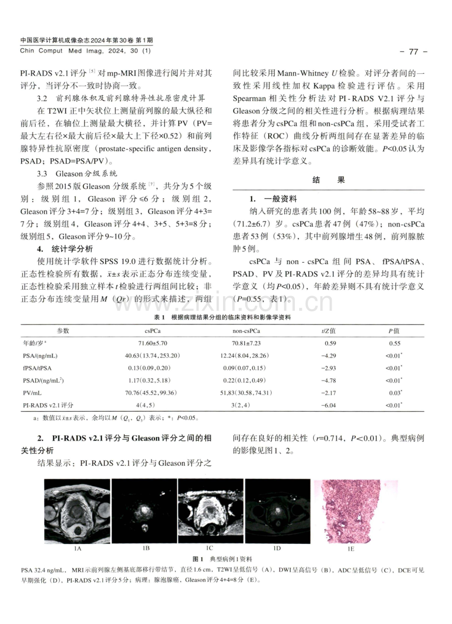 PI⁃RADS v2.1联合PSAD对前列腺显著癌的诊断价值.pdf_第3页