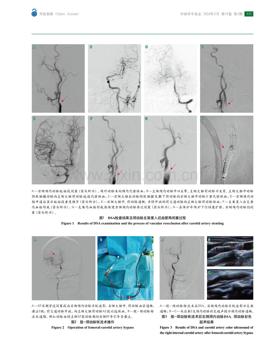 急性颈动脉闭塞支架置入术后血管再闭塞补救性治疗方法——股-颈动脉转流术报道.pdf_第3页