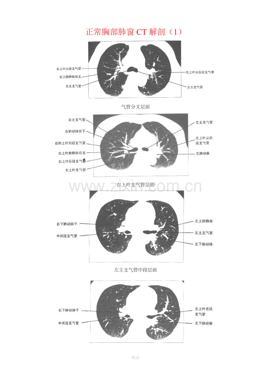 正常胸部CT解剖(肺窗和纵隔窗).doc_第1页