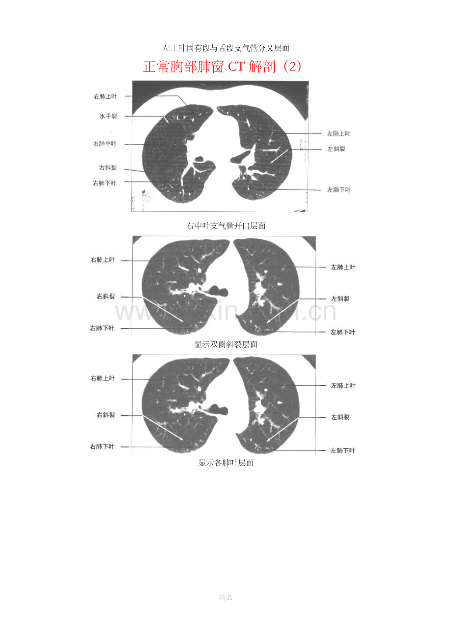 正常胸部CT解剖(肺窗和纵隔窗).doc_第2页