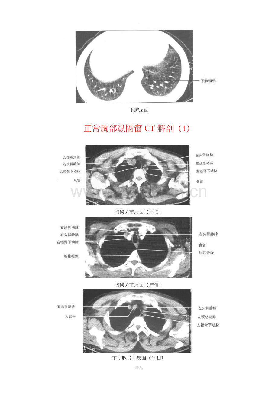 正常胸部CT解剖(肺窗和纵隔窗).doc_第3页