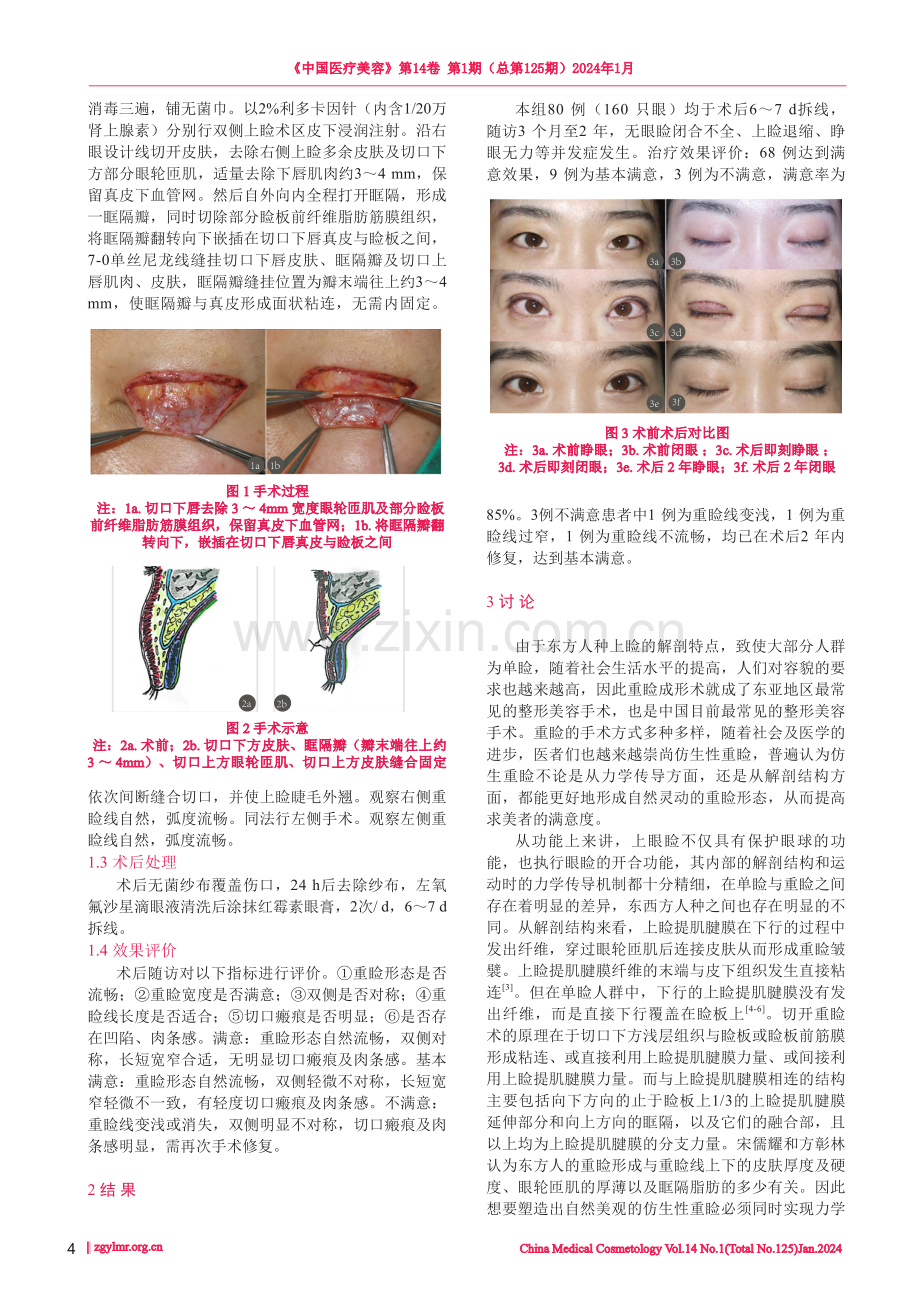 无需内固定的眶隔法重睑术.pdf_第2页