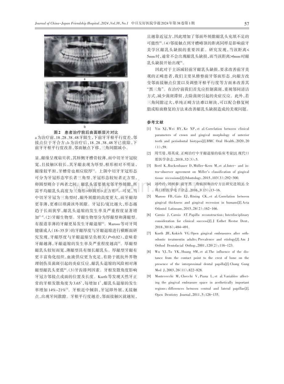 邻面去釉改善下前牙“黑三角”的无托槽隐形矫治.pdf_第2页