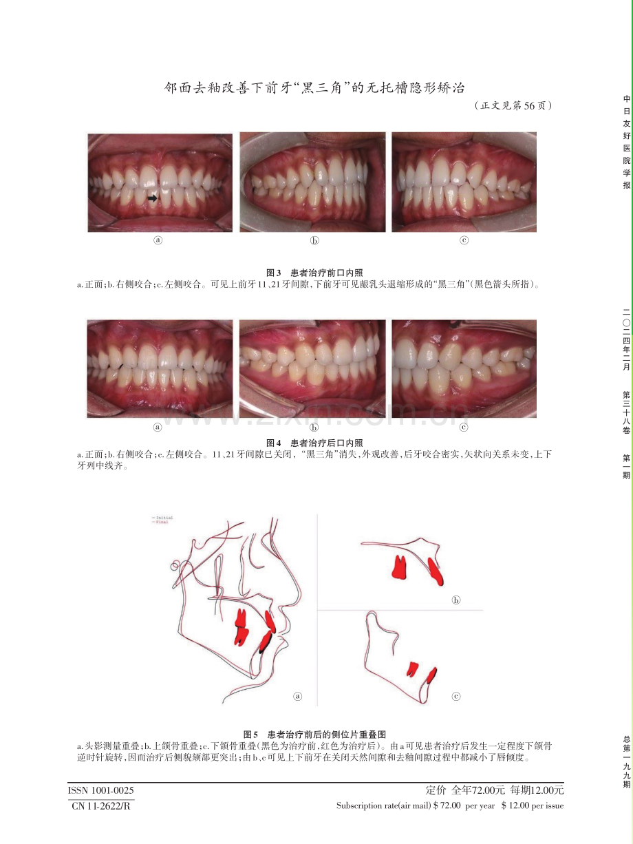 邻面去釉改善下前牙“黑三角”的无托槽隐形矫治.pdf_第3页