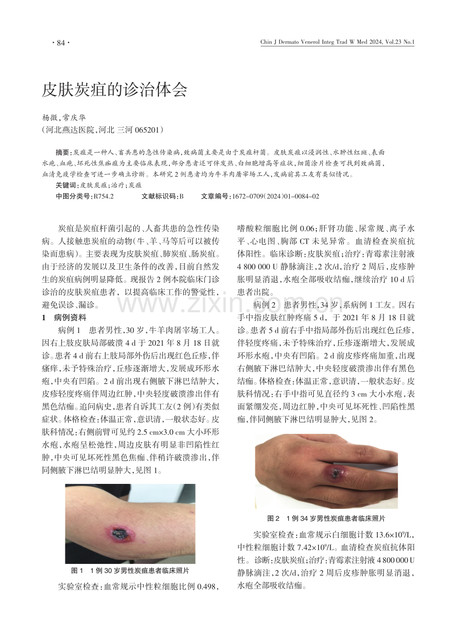 皮肤炭疽的诊治体会.pdf_第1页