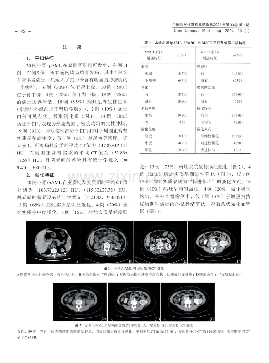 肾脏小乏脂血管平滑肌脂肪瘤的MSCT特征分析.pdf_第3页