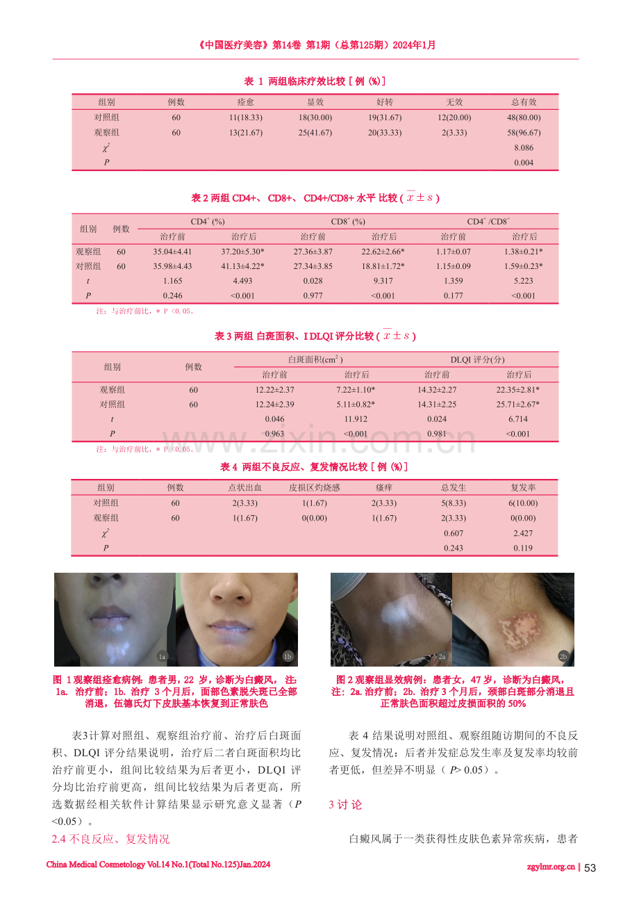 他克莫司软膏外涂辅助308nm紫外光照射治疗白癜风的临床获益分析.pdf_第3页