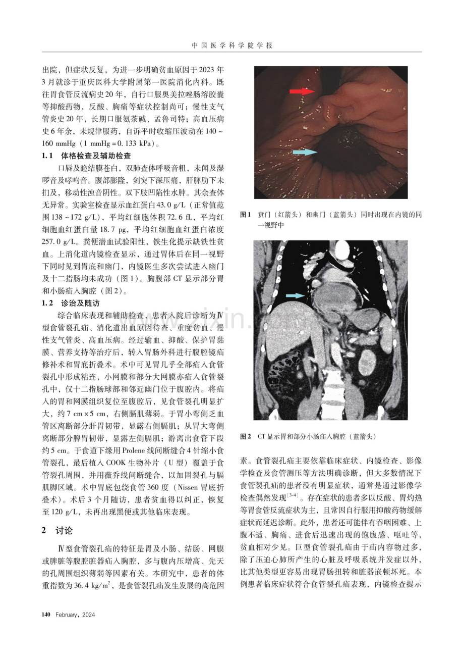 以重度贫血为主要临床表现的Ⅳ型食管裂孔疝一例.pdf_第2页