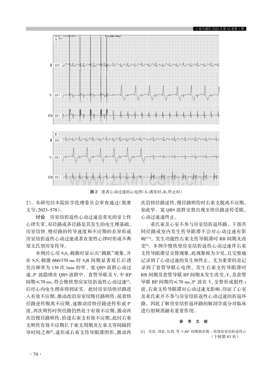 房室结折返性心动过速伴右束支传导阻滞呈交替现象1例.pdf_第2页